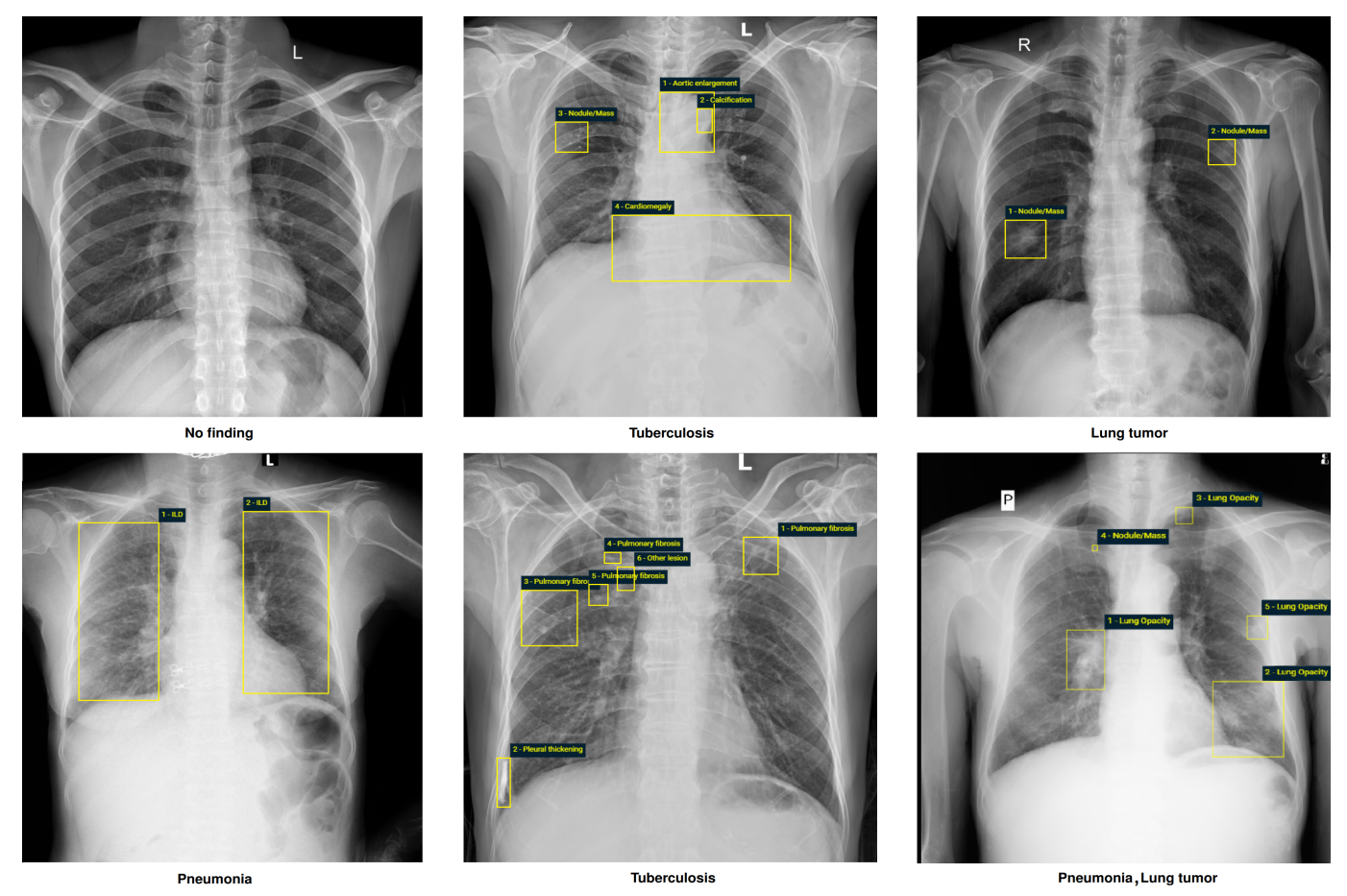 normal chest x ray labeled